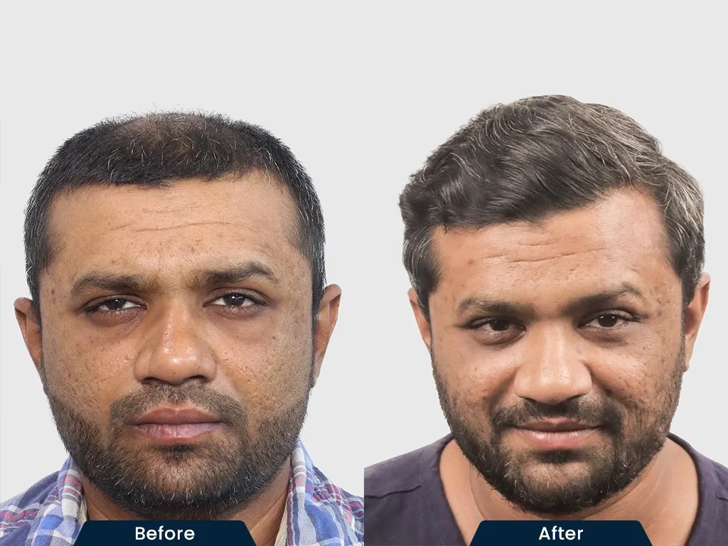 Crown Baldness result