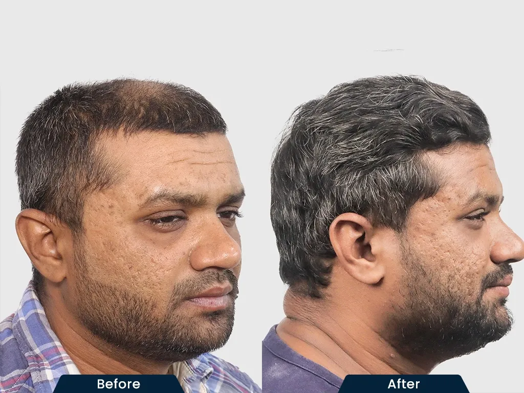 Crown Baldness result
