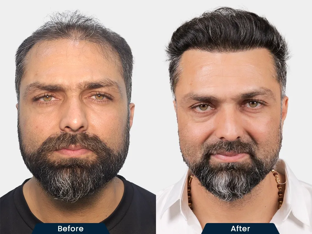 Full Baldness Solutions result