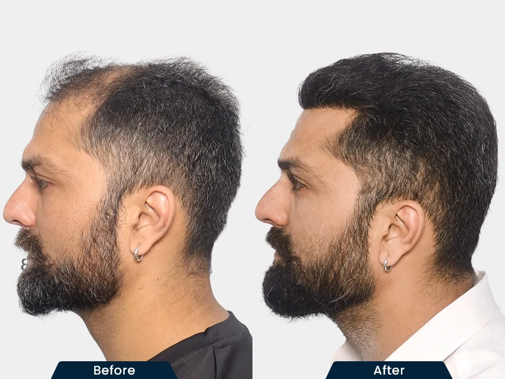 Full Baldness Solutions result