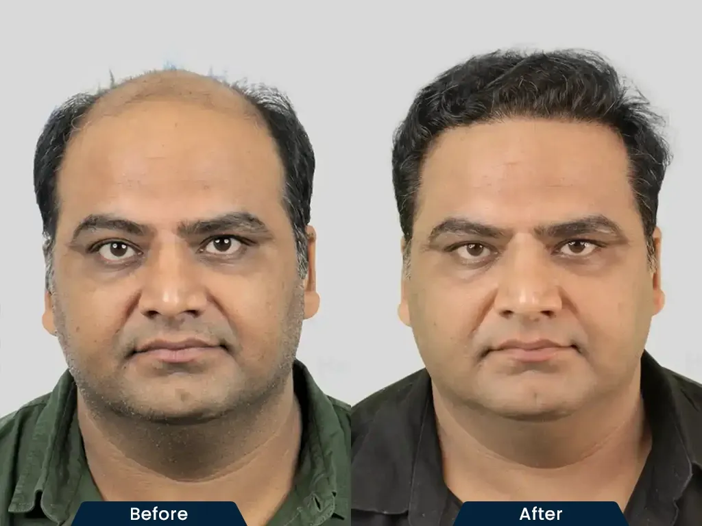 High Density Hair HT result
