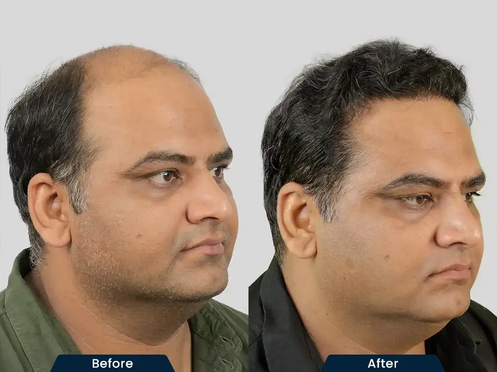 High Density Hair HT result