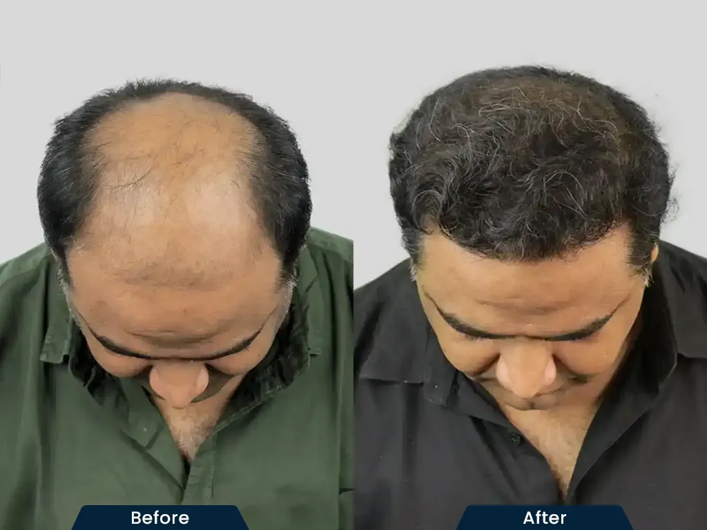 High Density Hair HT result
