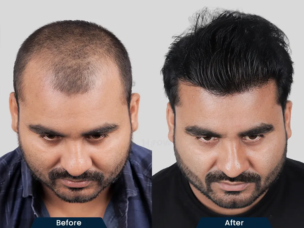 Hairline Restoration result