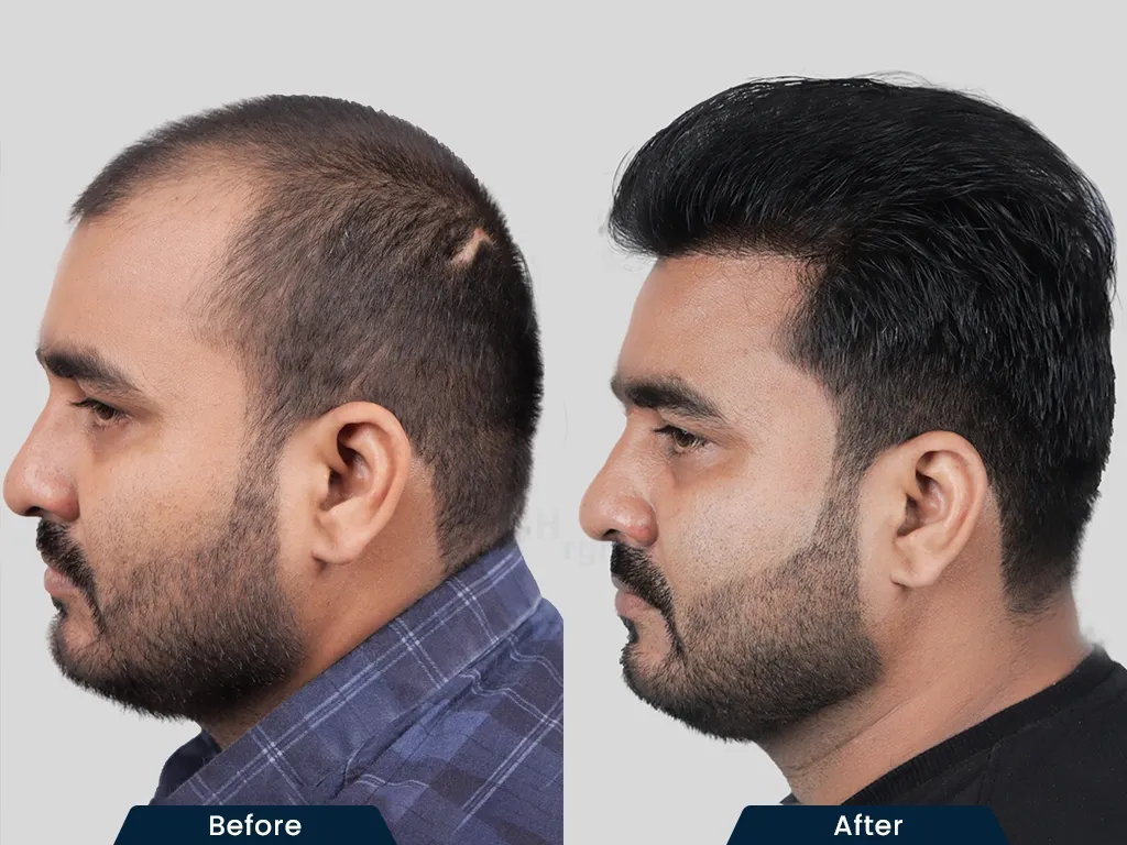 Hairline Restoration result