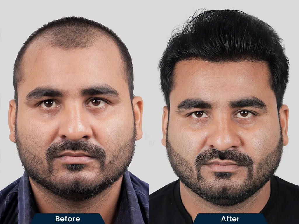 Hairline Restoration result
