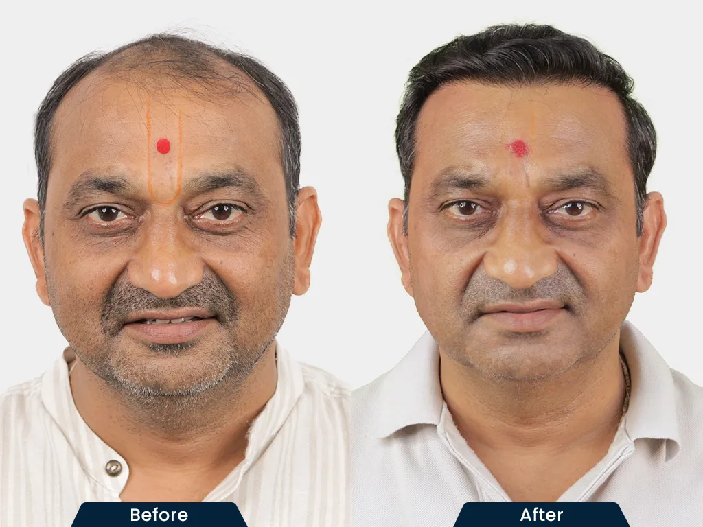 Natural Hair Transplant result
