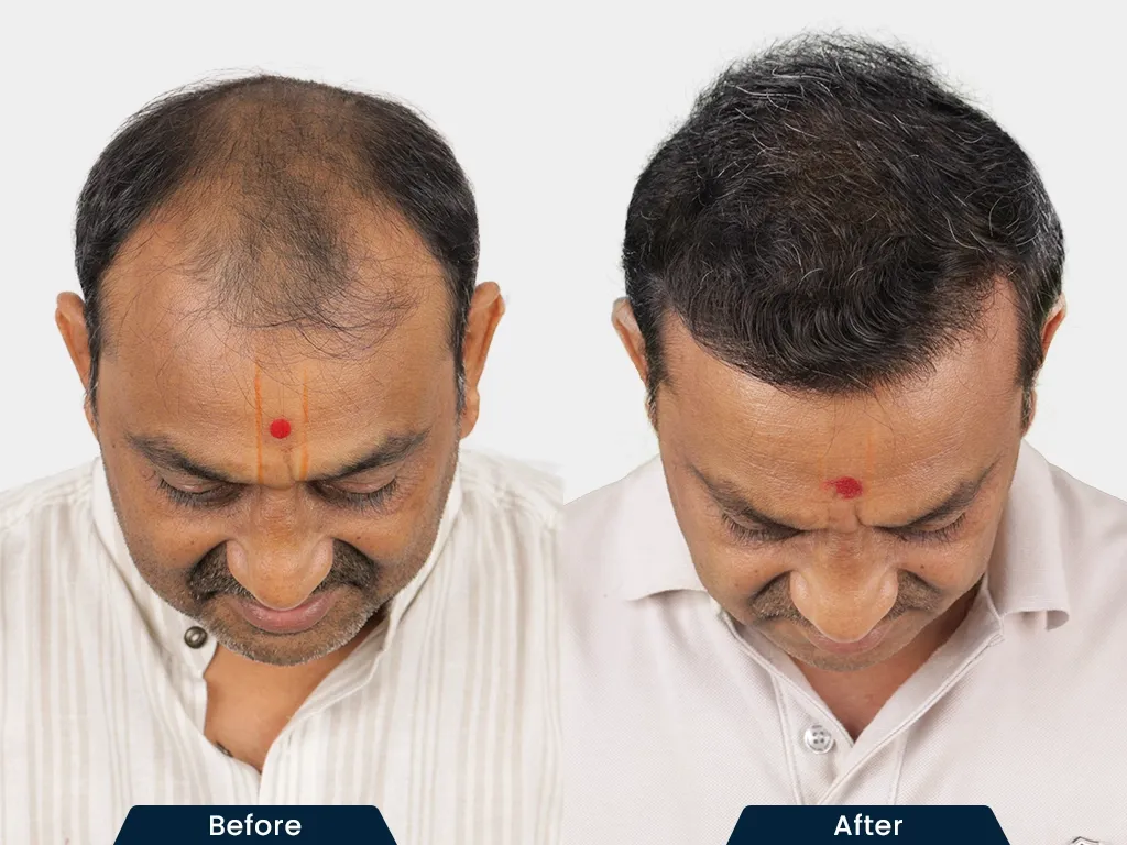 Natural Hair Transplant result